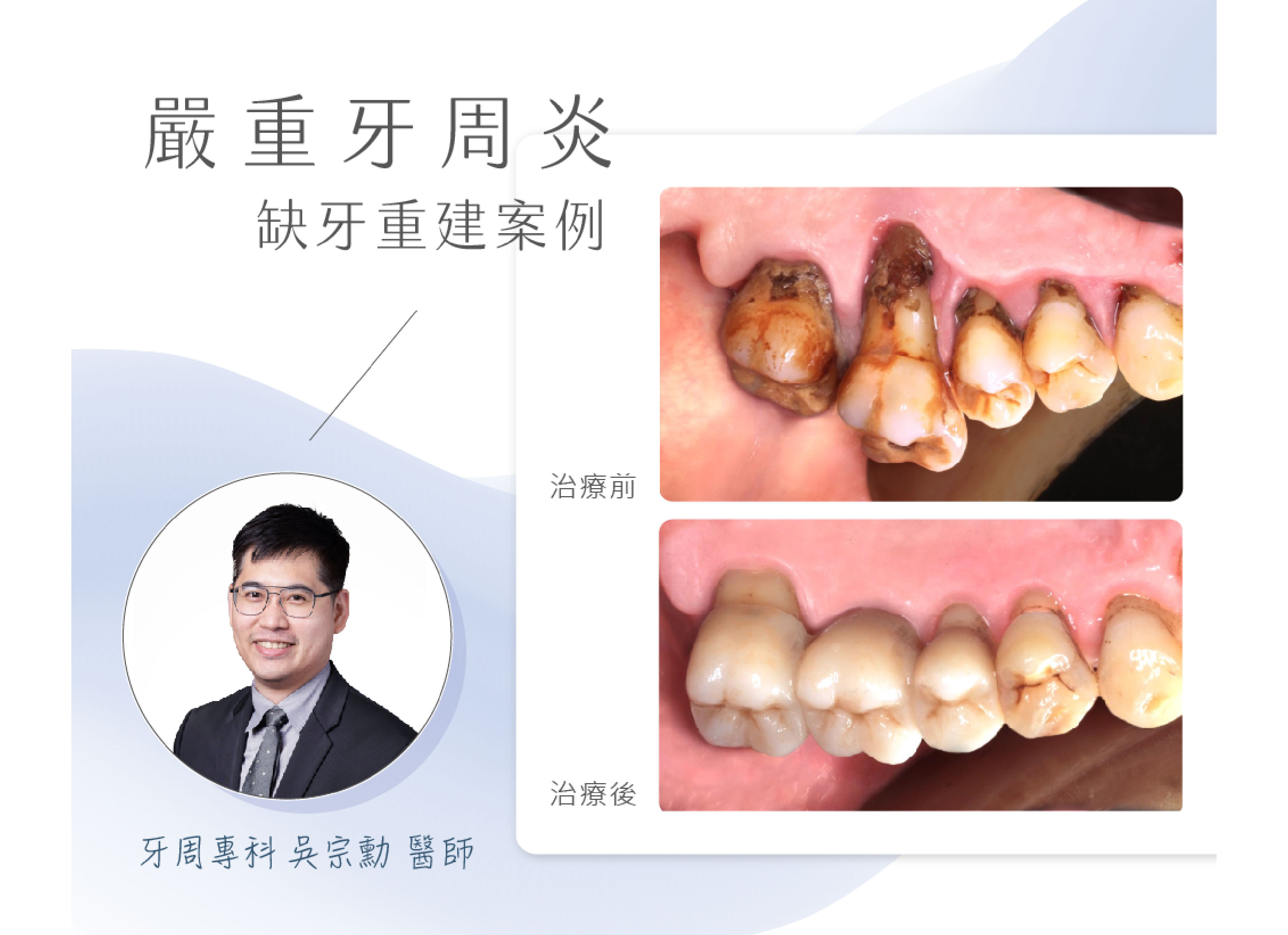 ❙ 咬合功能重建-全瓷牙橋 ❙ 牙周專科 吳宗勳醫師 案例分享