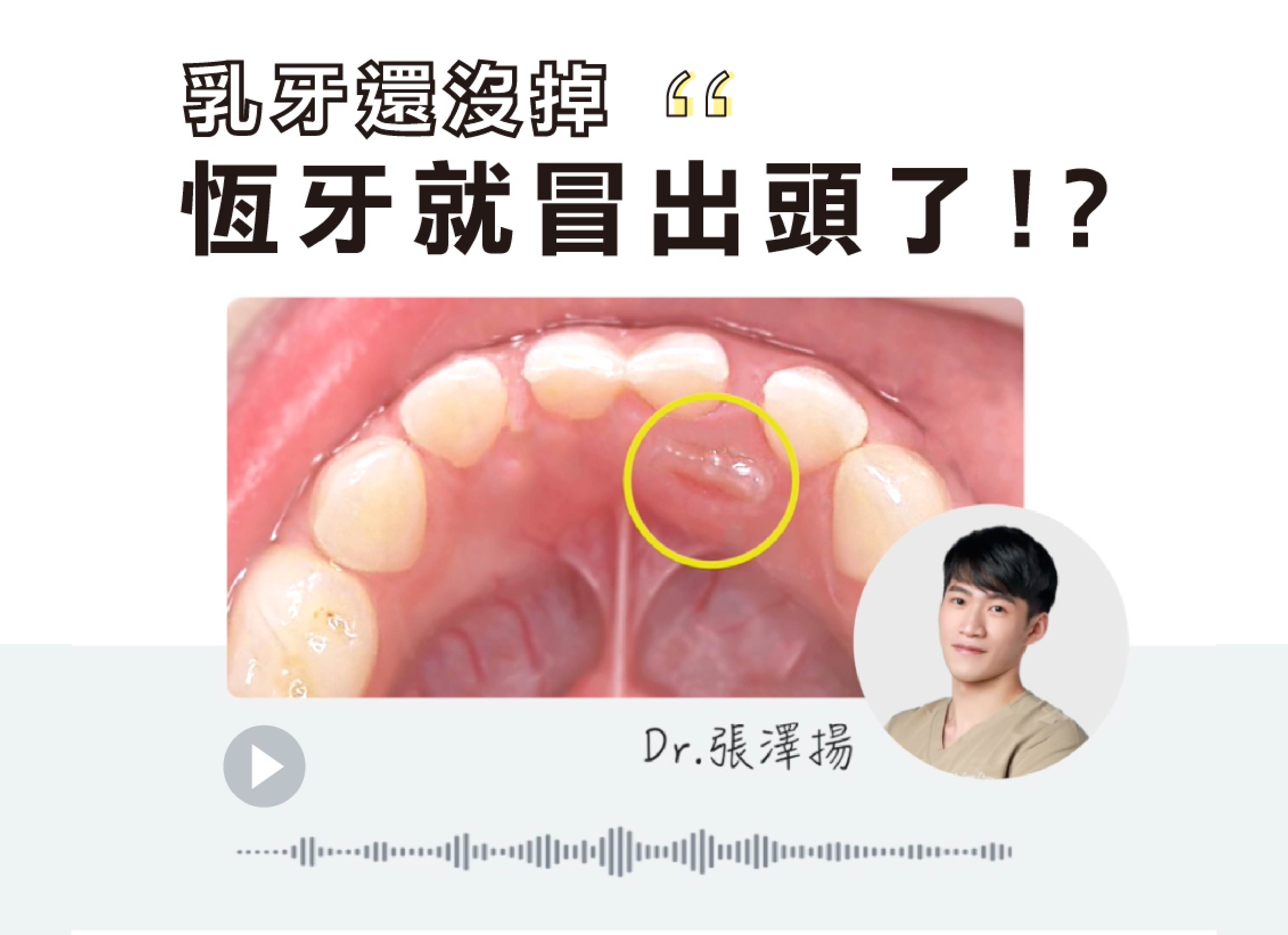乳牙沒掉，恆牙就冒出頭了!? 那要將小朋友的乳牙提前拔掉嗎？