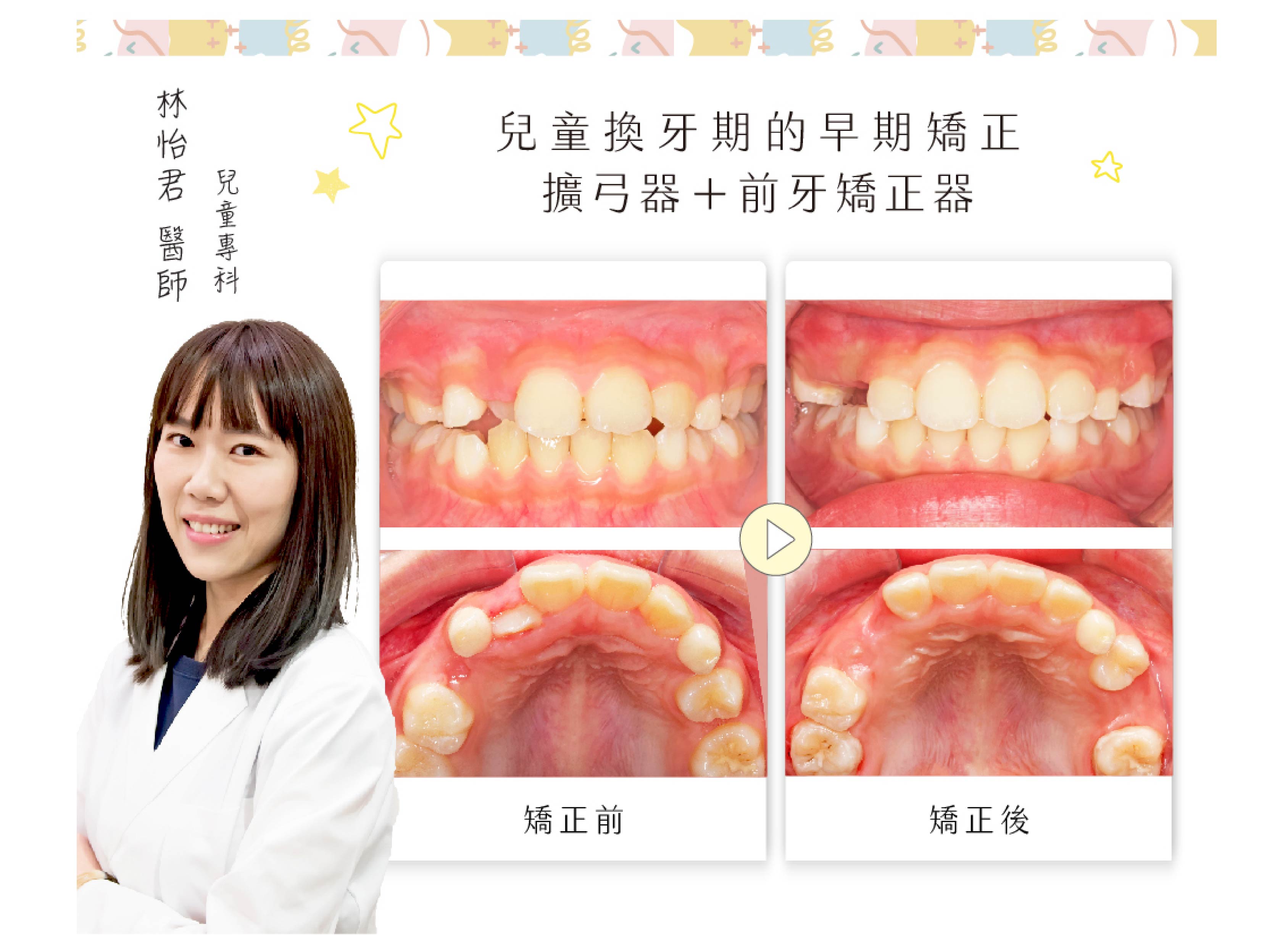 兒童專科 林怡君醫師 分享❙ 兒童換牙期的早期矯正：擴弓器＋前牙矯正器 ❙  