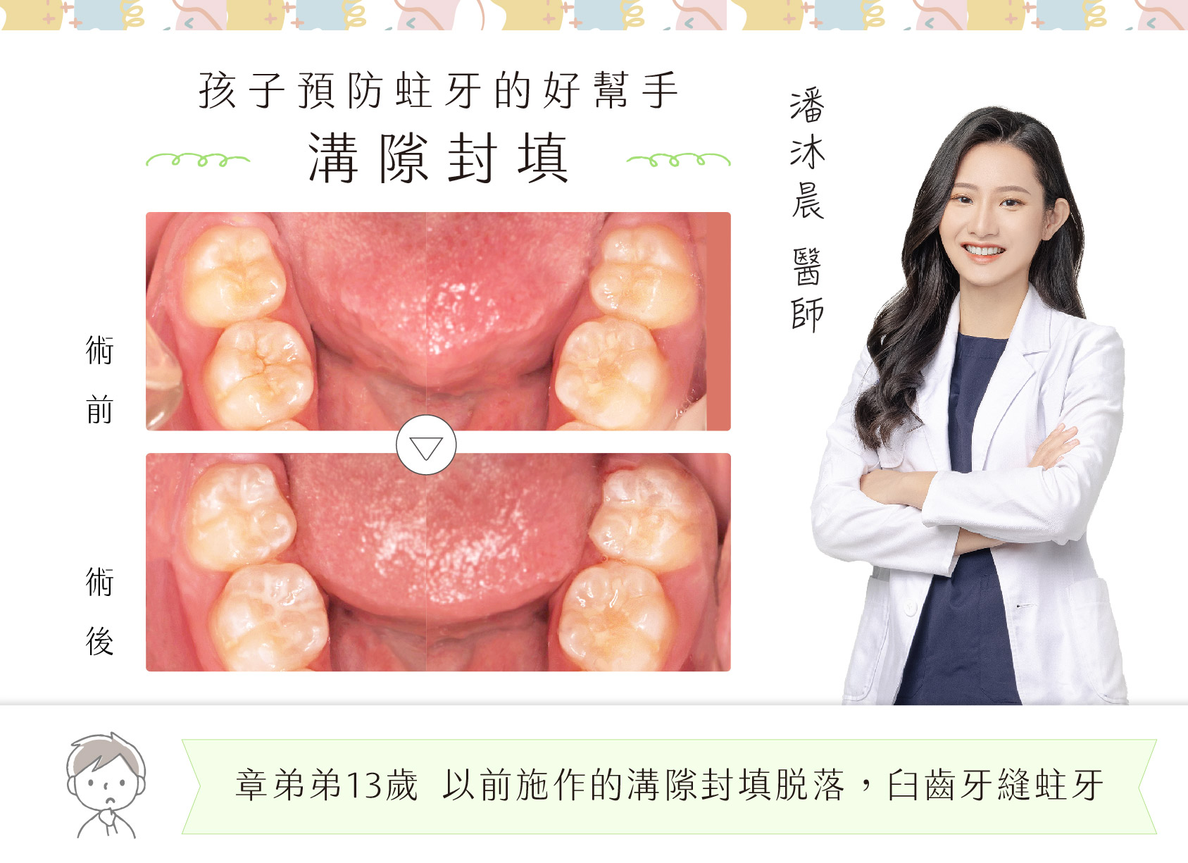 潘沐晨醫師-孩子預防蛀牙的好幫手：溝隙封填