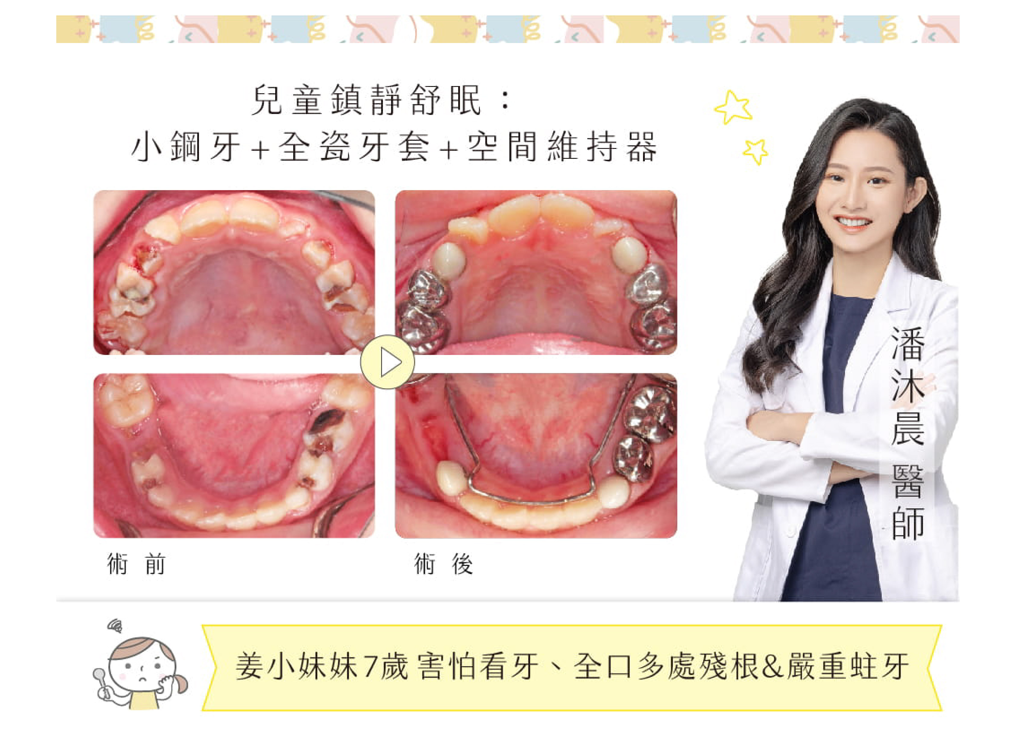 兒童鎮靜舒眠 : 小鋼牙＋全瓷牙套＋空間維持器 