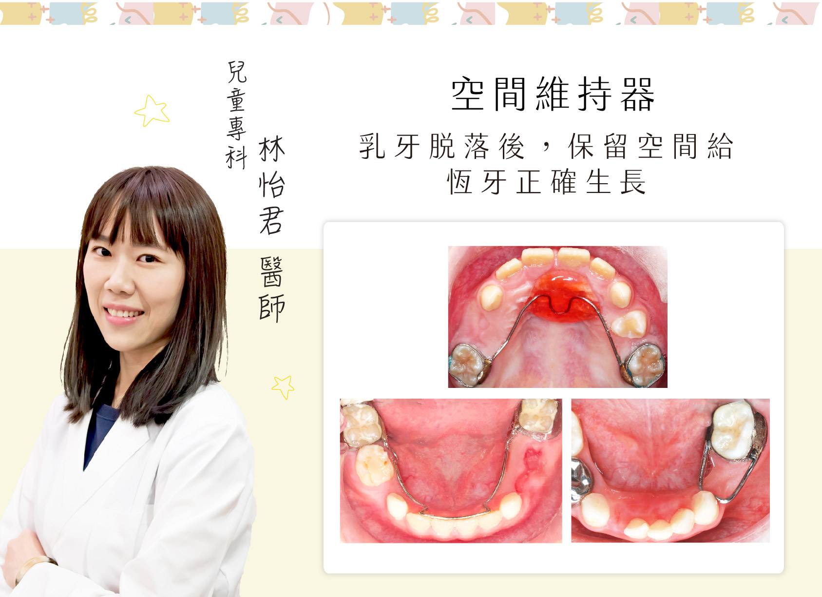 兒童專科 林怡君醫師介紹 - 乳牙提早脫落時，保留空間給的恆牙正確生長：空間維持器